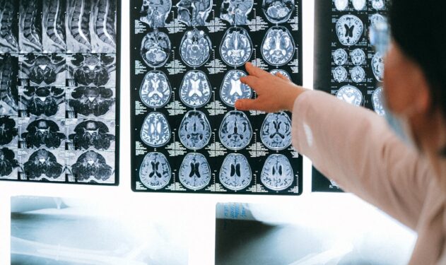 What Are the Lifelong Costs of a Traumatic Brain Injury